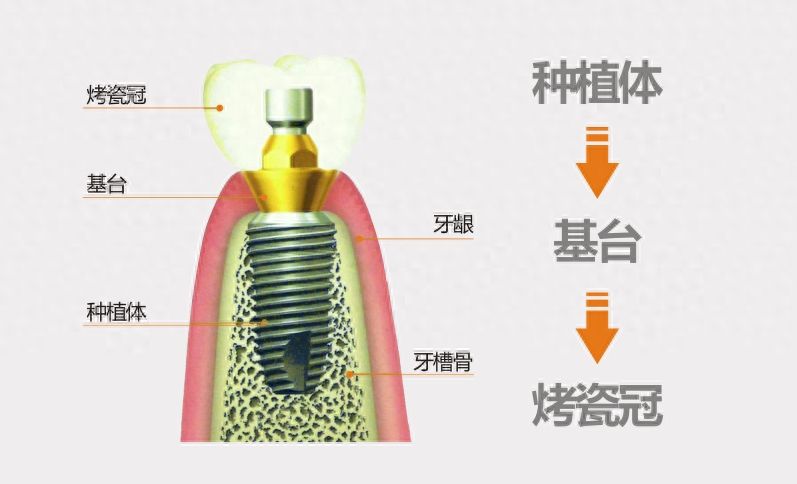 2025年湖北地区瑞士百丹特种植牙技术好的口腔医院推荐