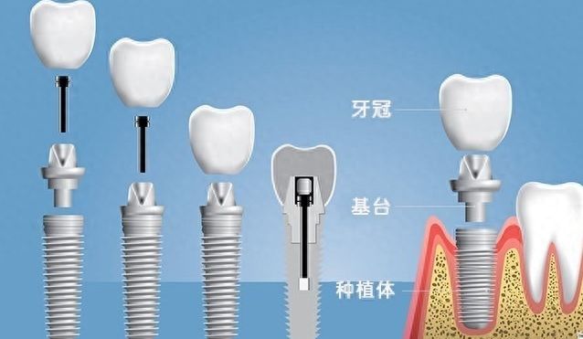 天津口腔医院价格查询，矫正、种植、补牙费用大揭秘！