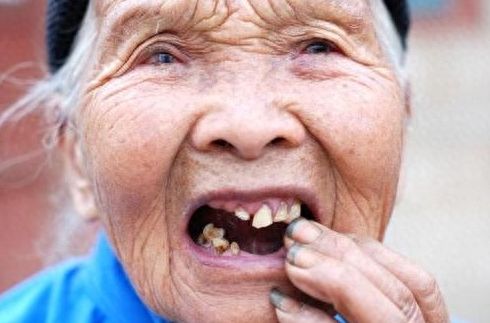天津诺尔口腔：数千元实惠，畅享种植牙的分分钟