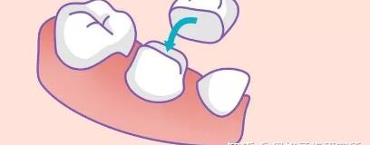 阳泉刘俊口腔：上颌骨矫正费用是如何定的？